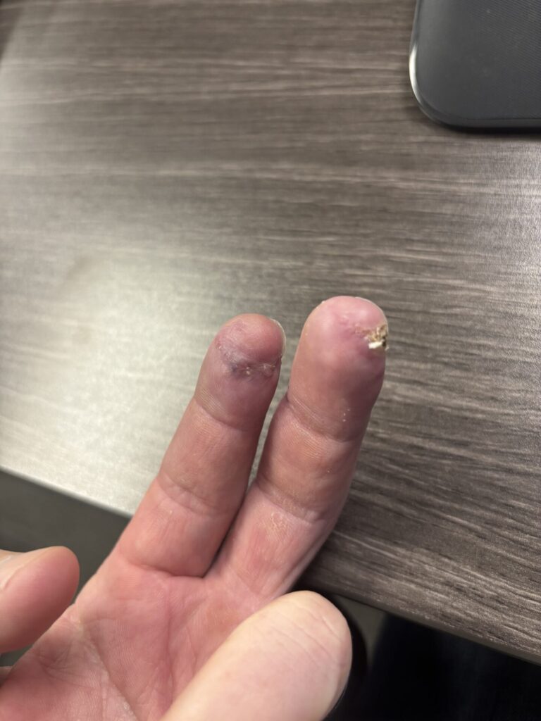 JS fingers healing after table saw accident
