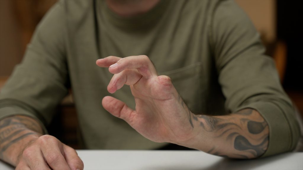 Cody Simmons showing his damaged left hand